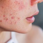 Acne: causas, efeitos e tratamentos eficazes